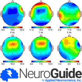eeg 2008年 NeuroGuide Deluxe QEEG v2.8.0